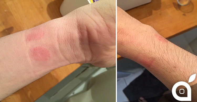 Apple Watch kann Hautreizungen verursachen-apple-watch-allergia-750x389.jpg