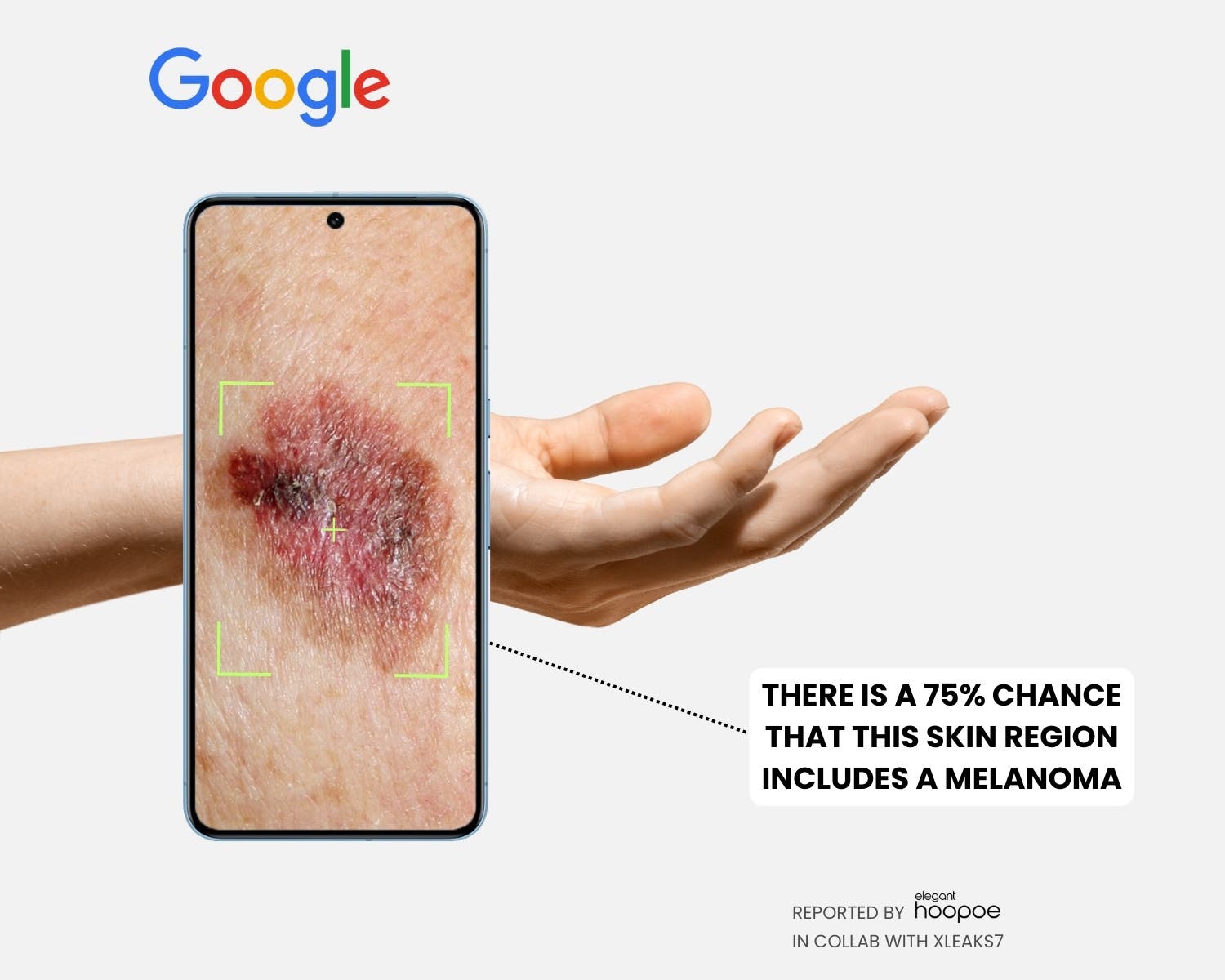 THERE IS A 75% CHANCE THAT THIS SKIN REGION INCLUDES A MELANOMA elegant REPORTED BY hoopoe IN COLLAB WITH XLEAKS7